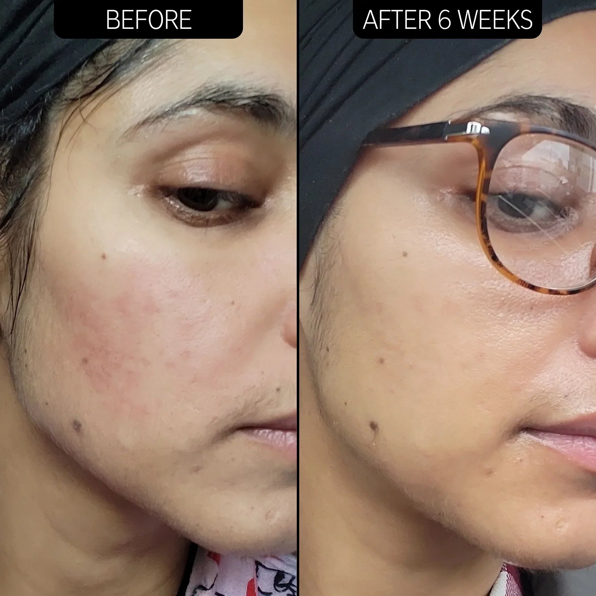 https://buraki.pk/products/the-inkey-list-redness-relief-10-azelaic-acid-serum