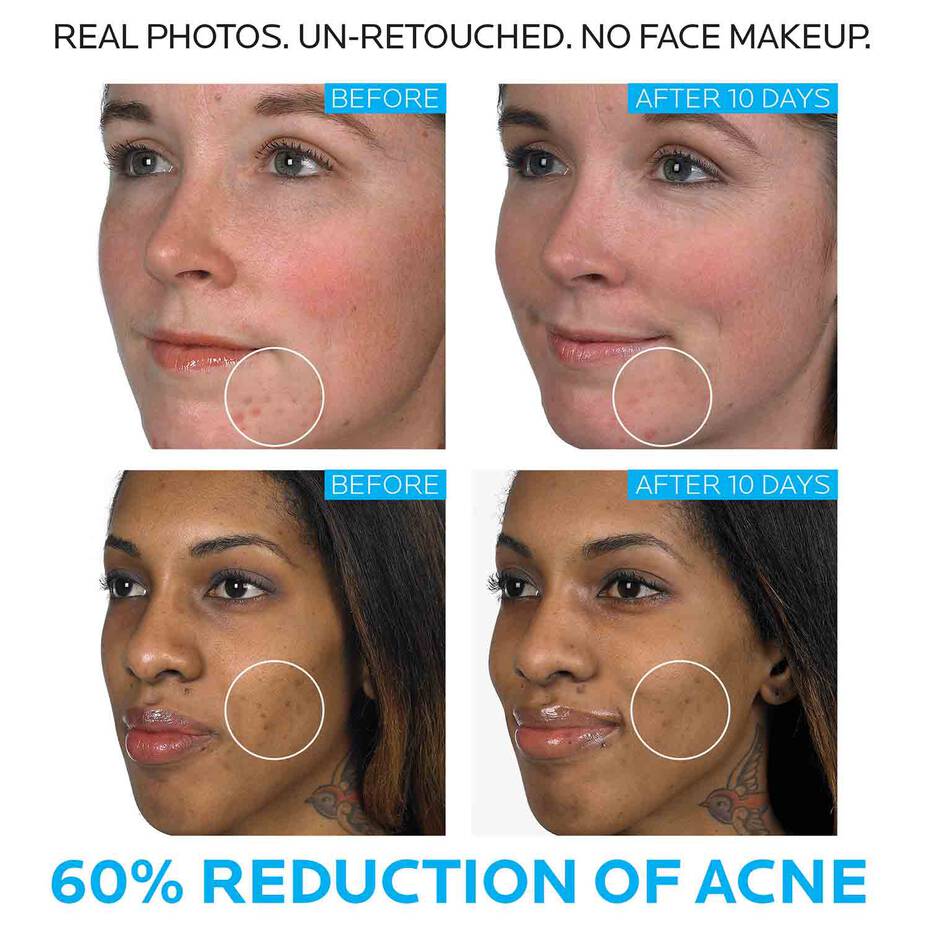 https://buraki.pk/products/la-roche-posay-effaclar-duo-acne-spot-treatment